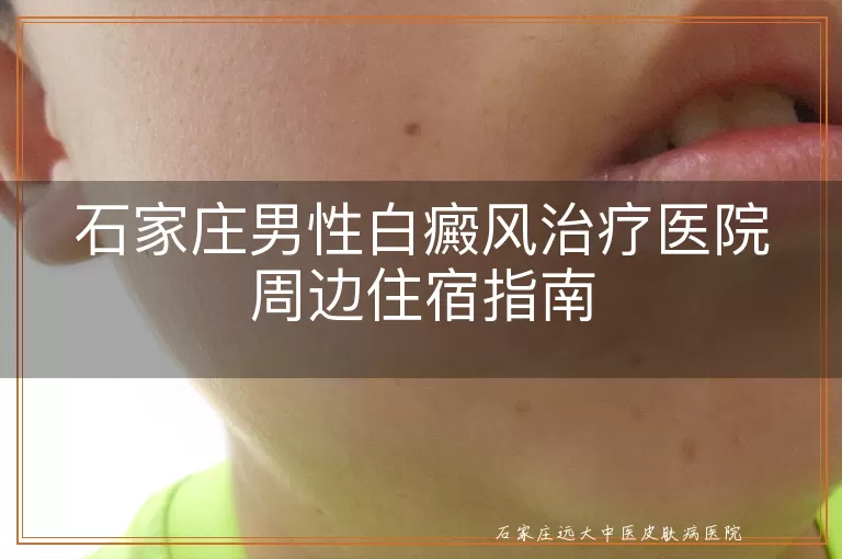 石家庄男性白癜风治疗医院周边住宿指南