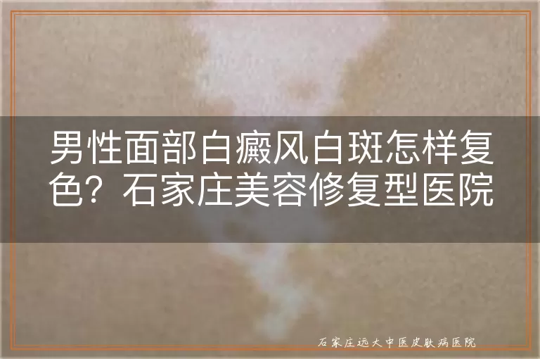 男性面部白癜风白斑怎样复色？石家庄美容修复型医院解读