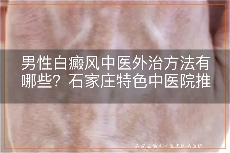 男性白癜风中医外治方法有哪些？石家庄特色中医院推荐