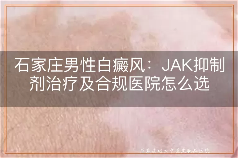 石家庄男性白癜风：JAK抑制剂治疗及合规医院怎么选