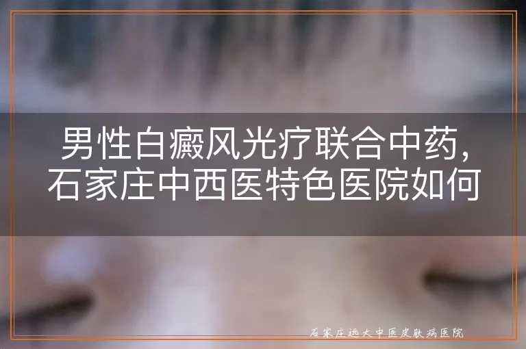 男性白癜风光疗联合中药，石家庄中西医特色医院如何系统应对