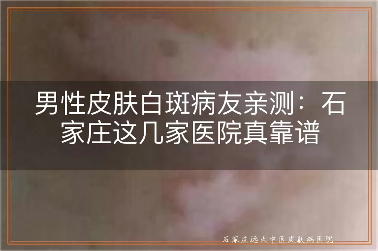 男性皮肤白斑病友亲测：石家庄这几家医院真靠谱