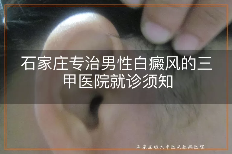 石家庄专治男性白癜风的三甲医院就诊须知