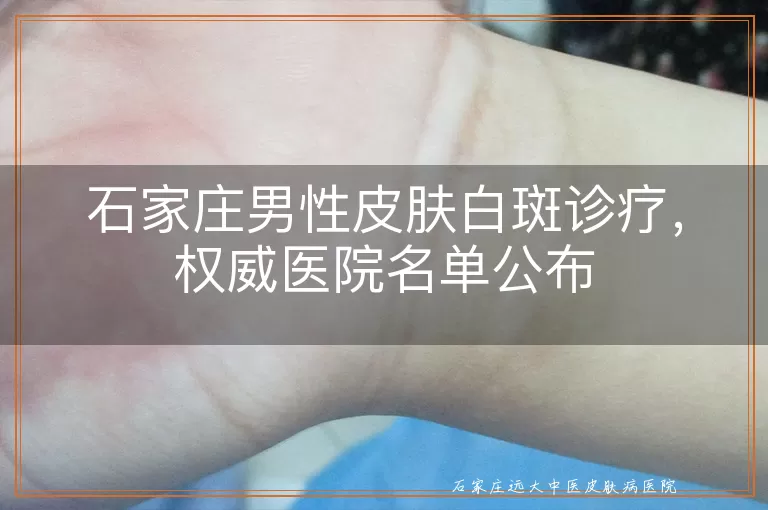 石家庄男性皮肤白斑诊疗,权威医院名单公布