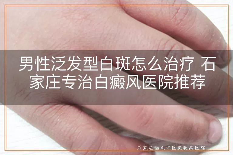 男性泛发型白斑怎么治疗 石家庄专治白癜风医院推荐
