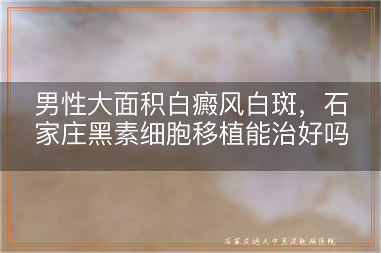 男性大面积白癜风白斑，石家庄黑素细胞移植能治好吗？