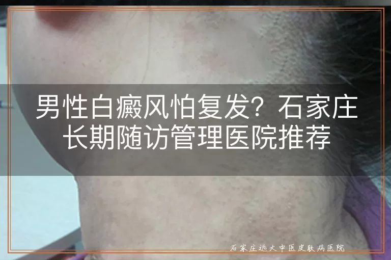 男性白癜风怕复发？石家庄长期随访管理医院推荐