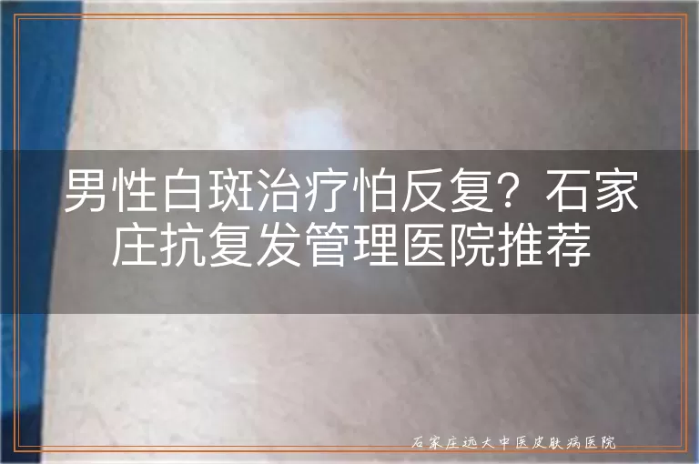 男性白斑治疗怕反复？石家庄抗复发管理医院推荐