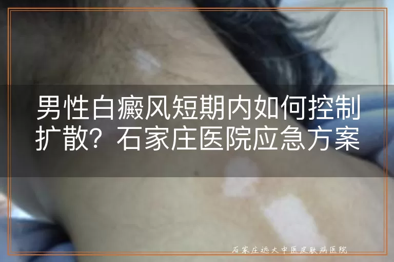 男性白癜风短期内如何控制扩散？石家庄医院应急方案推荐