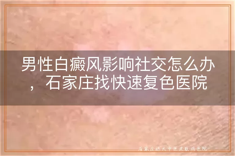 男性白癜风影响社交怎么办，石家庄找快速复色医院