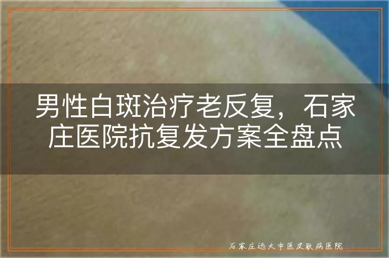 男性白斑治疗老反复，石家庄医院抗复发方案全盘点