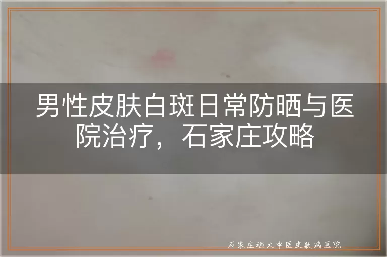 男性皮肤白斑日常防晒与医院治疗，石家庄攻略