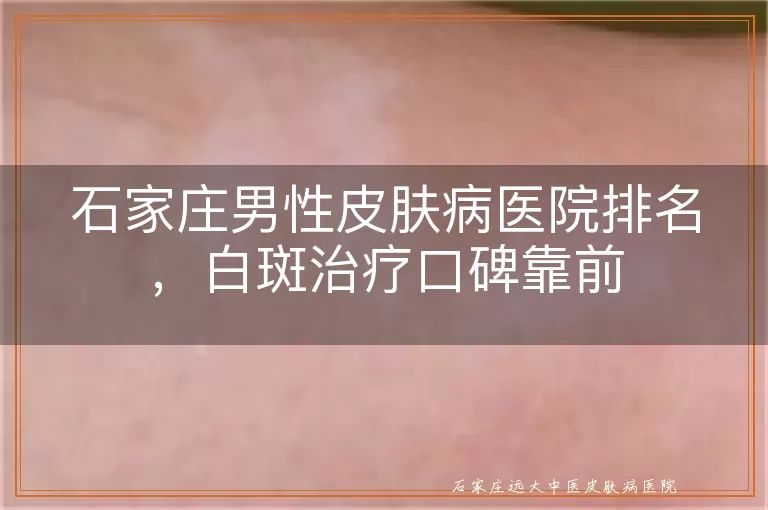 石家庄男性皮肤病医院排名，白斑治疗口碑靠前