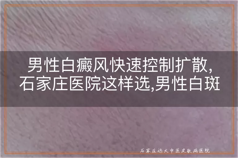 男性白癜风快速控制扩散，石家庄医院这样选,男性白斑扩散期的控制与医院推荐,石家庄男性白癜风治疗医院怎么挑