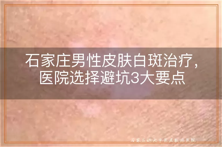 石家庄男性皮肤白斑治疗，医院选择避坑3大要点