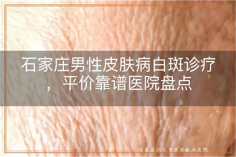 石家庄男性皮肤病白斑诊疗，平价靠谱医院盘点