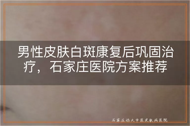 男性皮肤白斑康复后巩固治疗，石家庄医院方案推荐