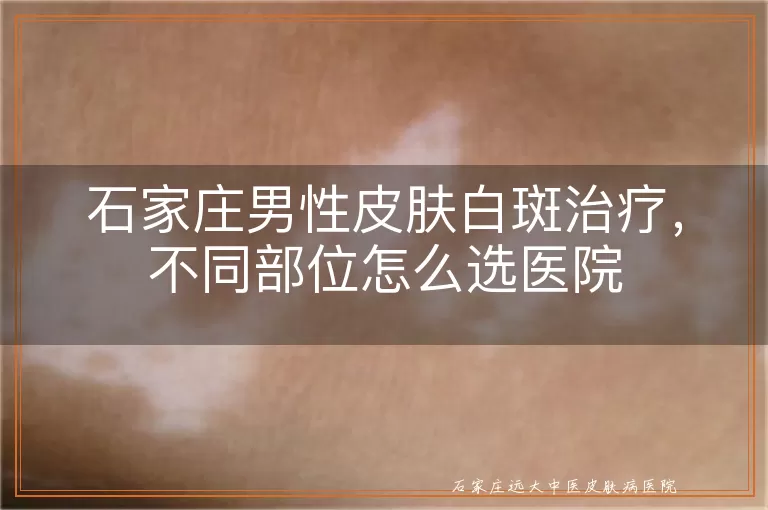 石家庄男性皮肤白斑治疗，不同部位怎么选医院