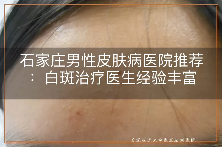 石家庄男性皮肤病医院推荐：白斑治疗医生经验丰富