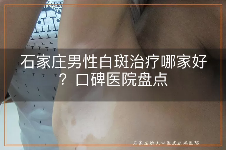 石家庄男性白斑治疗哪家好？口碑医院盘点