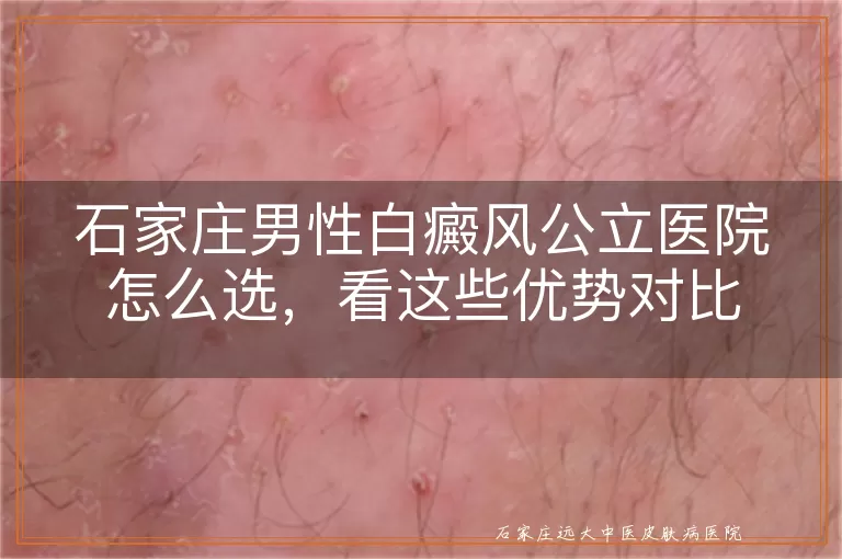 石家庄男性白癜风公立医院怎么选，看这些优势对比