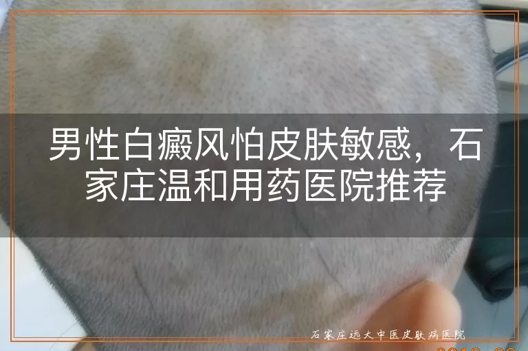 男性白癜风怕皮肤敏感,石家庄温和用药医院推荐