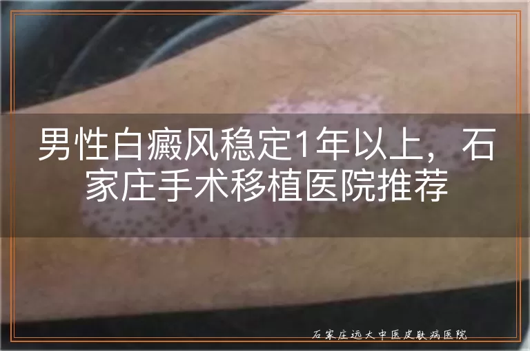 男性白癜风稳定1年以上,石家庄手术移植医院推荐