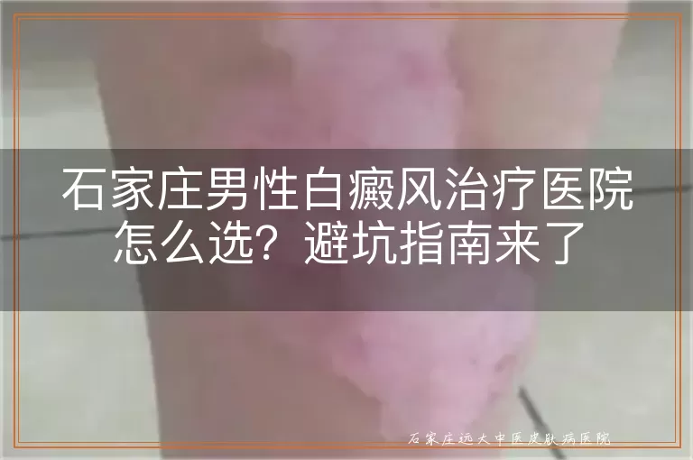 石家庄男性白癜风治疗医院怎么选？避坑指南来了