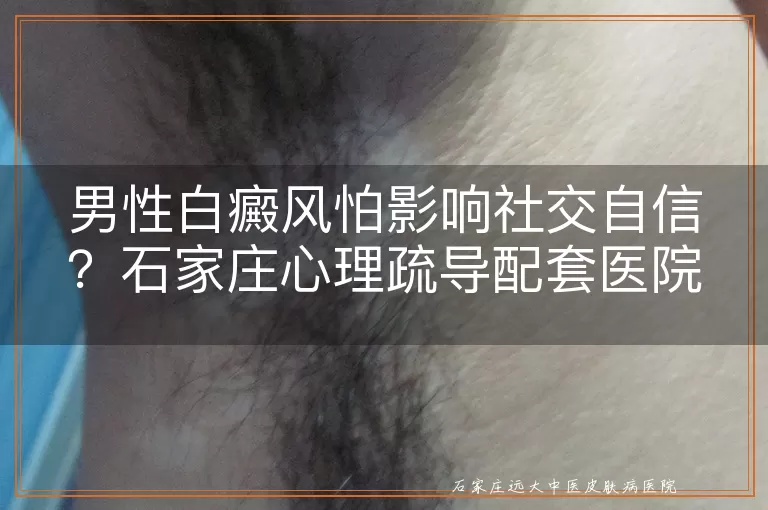 男性白癜风怕影响社交自信？石家庄心理疏导配套医院帮解忧