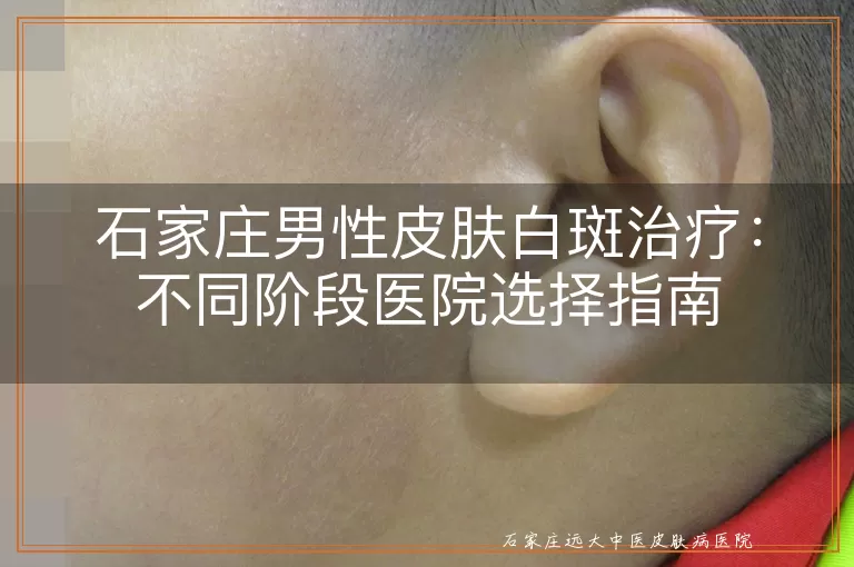石家庄男性皮肤白斑治疗：不同阶段医院选择指南