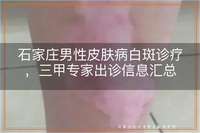 石家庄男性皮肤病白斑诊疗，三甲专家出诊信息汇总