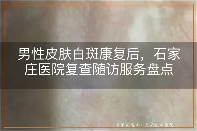 男性皮肤白斑康复后，石家庄医院复查随访服务盘点
