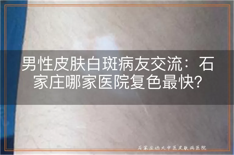 男性皮肤白斑病友交流:石家庄哪家医院复色最快?