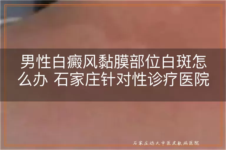 男性白癜风黏膜部位白斑怎么办 石家庄针对性诊疗医院怎么选