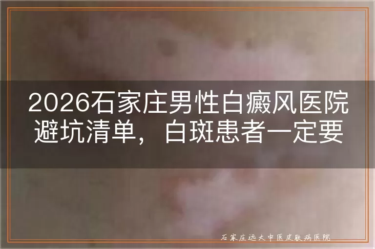 2026石家庄男性白癜风医院避坑清单，白斑患者一定要看