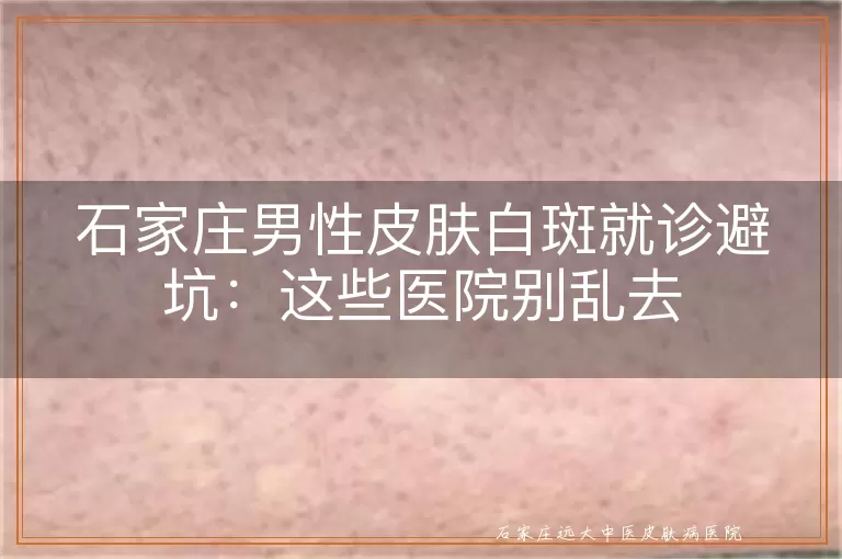 石家庄男性皮肤白斑就诊避坑：这些医院别乱去