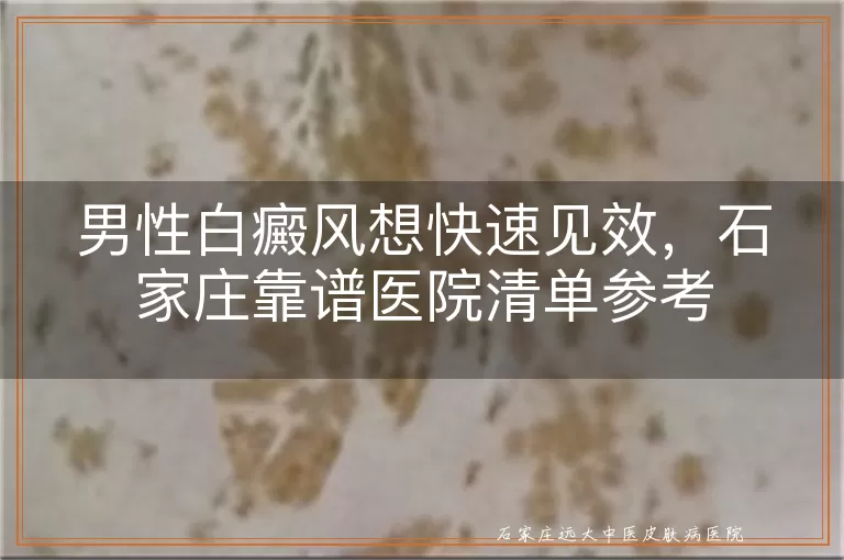 男性白癜风想快速见效，石家庄靠谱医院清单参考