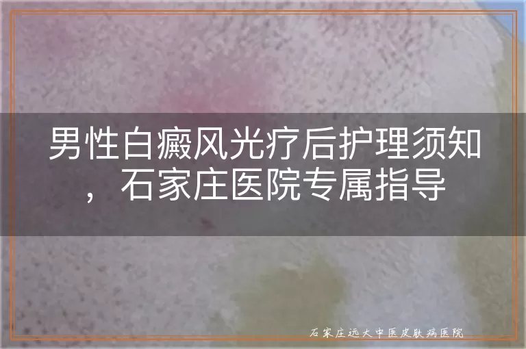 男性白癜风光疗后护理须知，石家庄医院专属指导