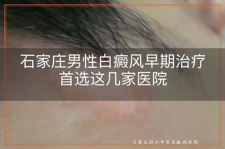 石家庄男性白癜风早期治疗首选这几家医院