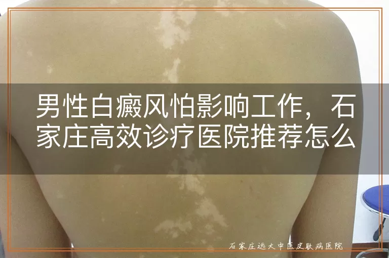 男性白癜风怕影响工作，石家庄高效诊疗医院推荐怎么办