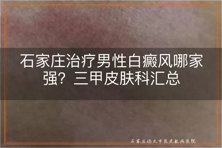 石家庄治疗男性白癜风哪家强？三甲皮肤科汇总