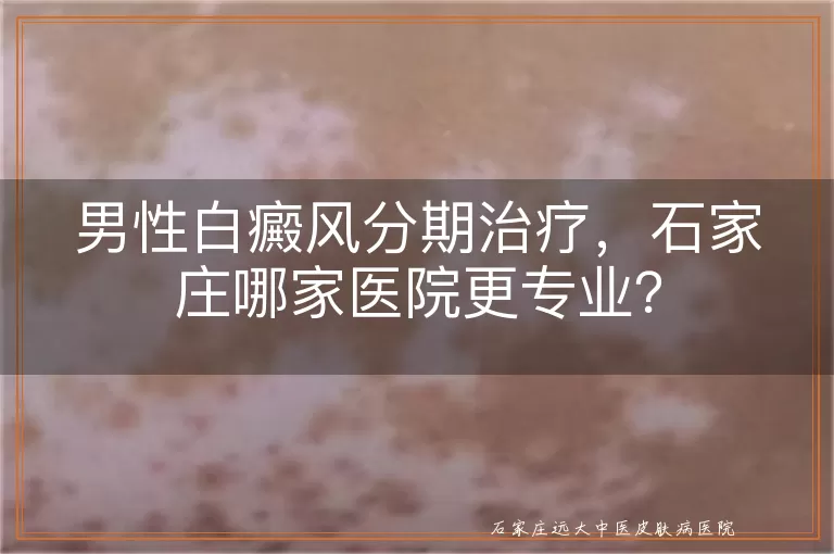 男性白癜风分期治疗，石家庄哪家医院更专业？