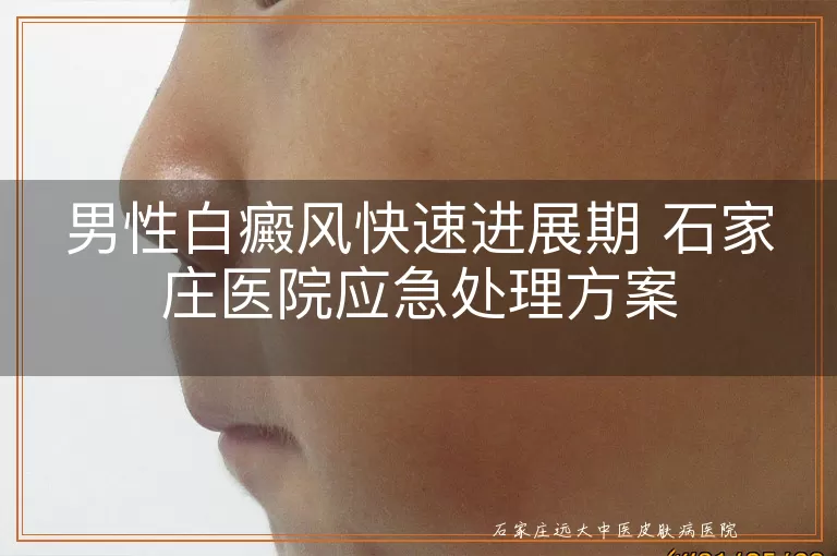 男性白癜风快速进展期 石家庄医院应急处理方案