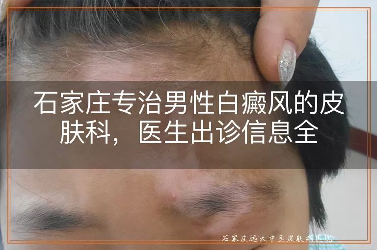 石家庄专治男性白癜风的皮肤科，医生出诊信息全