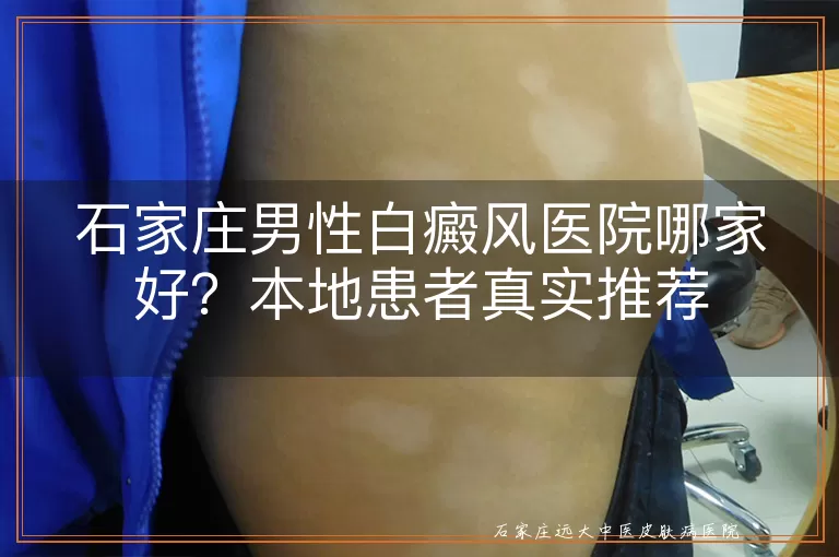 石家庄男性白癜风医院哪家好？本地患者真实推荐