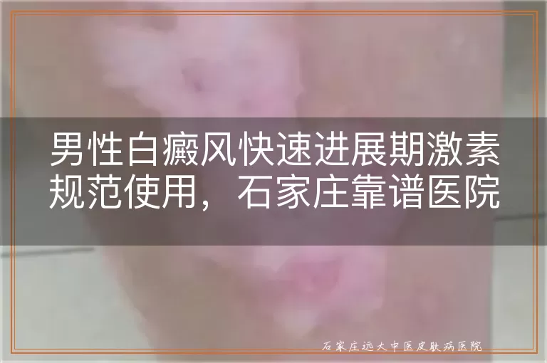 男性白癜风快速进展期激素规范使用，石家庄靠谱医院详解