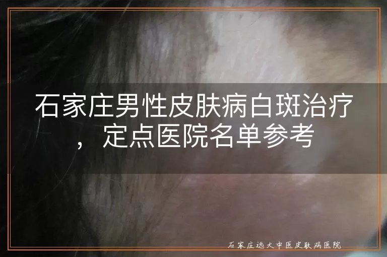 石家庄男性皮肤病白斑治疗，定点医院名单参考