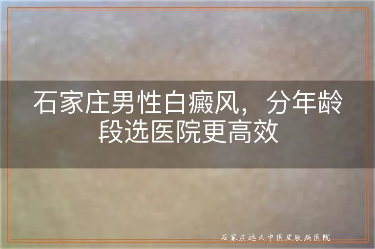 石家庄男性白癜风，分年龄段选医院更高效