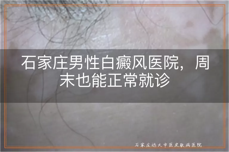 石家庄男性白癜风医院，周末也能正常就诊