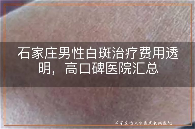 石家庄男性白斑治疗费用透明，高口碑医院汇总